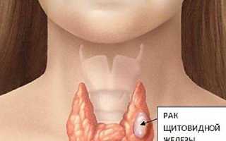 Нетоксический многоузловой зоб: причины, симптомы, методы лечения, отзывы