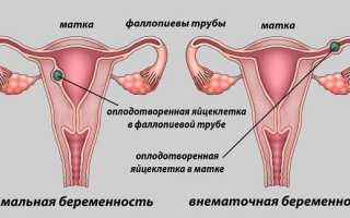 Внематочная беременность: диагностика, лечение, реабилитация