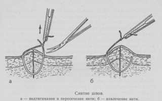 Швы после родов — виды, особенности наложения, этапы заживления и как долго швы могут беспокоить