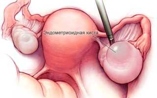 Киста яичника лечение без операции, как удалить эндометриоидную кисту без операции