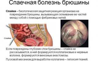 Могут ли спайки стать непреодолимой преградой беременности?