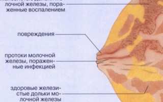 Молочница грудных желёз у кормящей мамы: симптомы и методы лечения