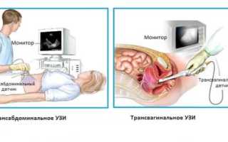 При каких размерах кисты яичника назначается операция