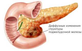 Диффузные изменения поджелудочной железы: что это такое, причины и как лечить