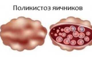 Стесняюсь спросить. У меня поликистоз, и я не могу забеременеть – что делать?