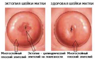 Самые эффективные народные средства для лечения эрозии шейки матки: рейтинг лучших рецептов