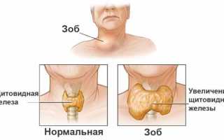 Эндемический зоб — симптомы, лечение и профилактика