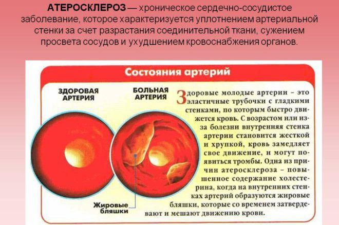 Атеросклероз