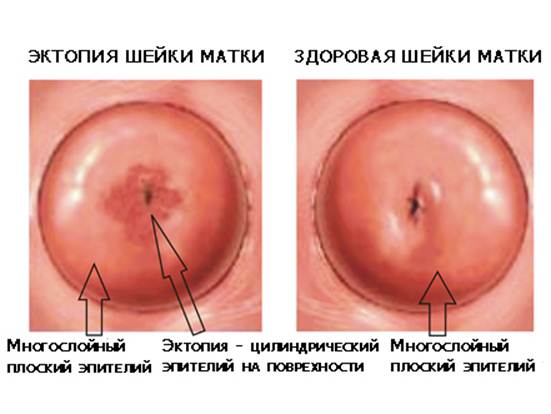 Эрозия шейки матки: симптомы, признаки, диагностика и лечение - NeBolet.com