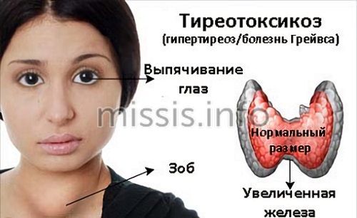 Как определить тиреотоксикоз