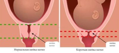 Какая шейка матки при беременности до задержки 7
