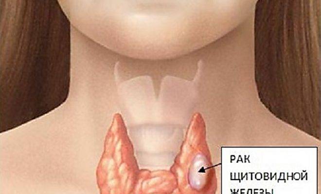 калькульозно дегенерующий узловой зоб