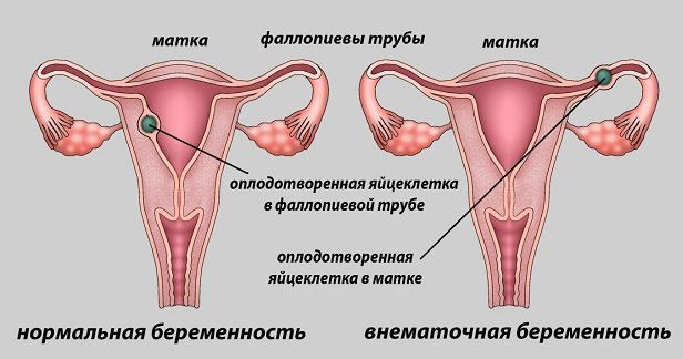 матка